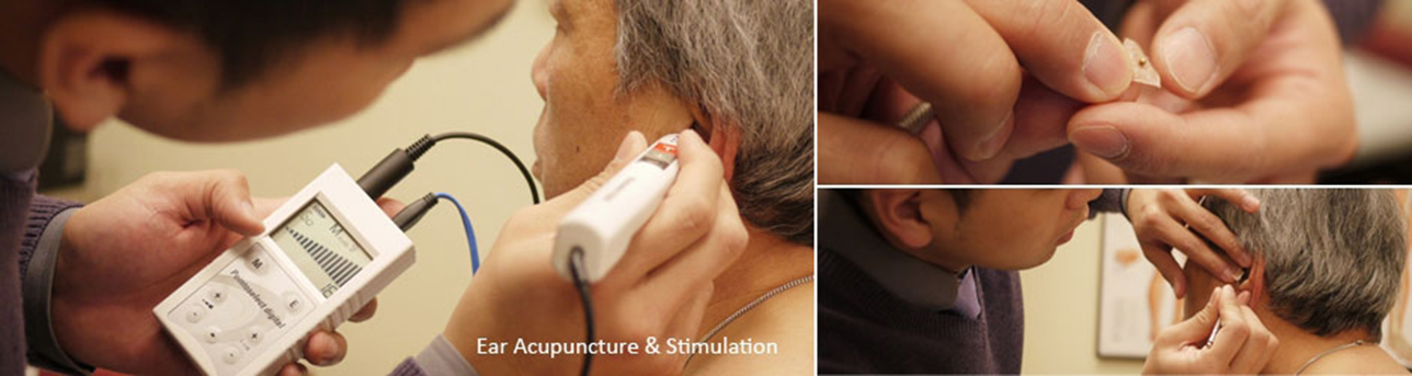 ear_acupuncture